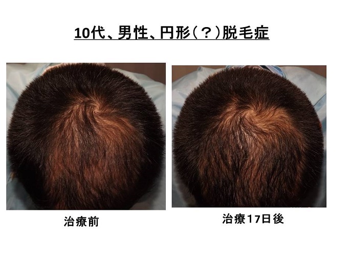 円形脱毛症　病院